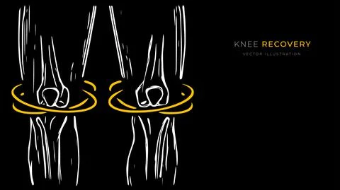Vector illustration of knee recovery. Creative medical poster or banner. Stock Illustration