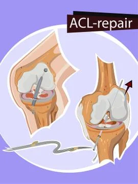 Vector illustration of Knee repair Stock Illustration