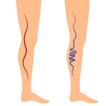 Vector illustration leg veins Illustrazione stock
