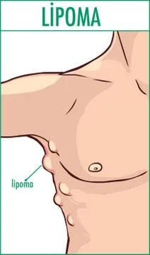 Vector illustration of a lipoma. Illustrazione stock
