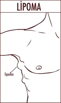 Vector illustration of a lipoma. Stock Illustration