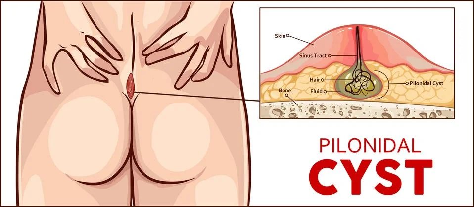 Vector illustration Pilonidal cyst formation Stock Illustration