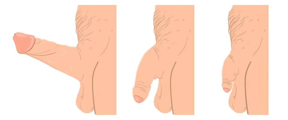 Vector illustration of problems in andrology. For publication in medical Stock Illustration