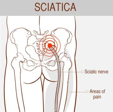 Vector illustration of sciatica Stock Illustration