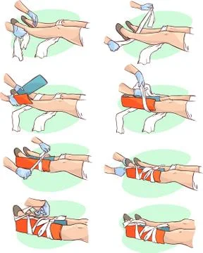 Vector illustration of a Splinting a Broken leg Stock Illustration