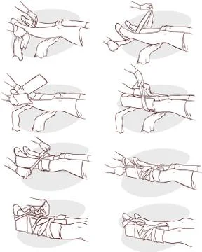 Vector illustration of a Splinting a Broken leg Illustration
