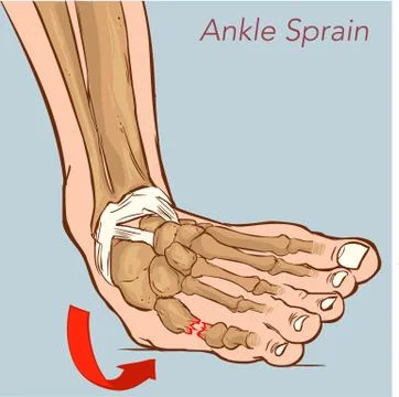 Vector illustration of a Sprained ankle. Stock Illustration