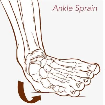 Vector illustration of a Sprained ankle. Stock Illustration