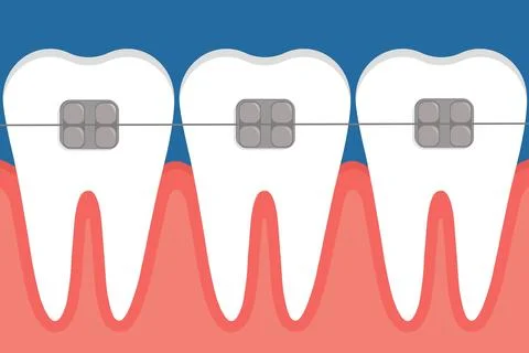 Vector illustration of teeth with braces. Stock Illustration