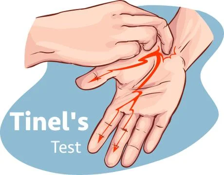 Vector illustration of a Tinel's test Stock Illustration