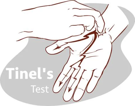 Vector illustration of a Tinel's test Stock Illustration