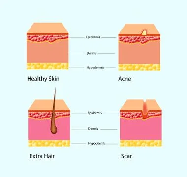 Vector illustration of types of skin problems isolated Stock Illustration