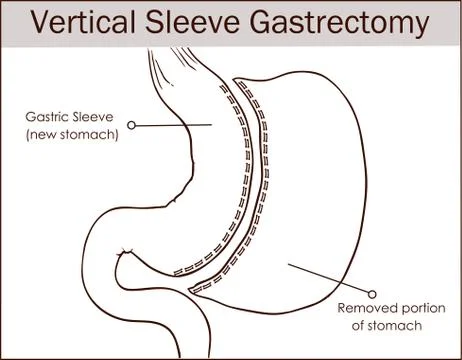 Vector illustration of Vertical Sleeve Gastrectomy. Stock Illustration