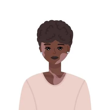 Vector illustration of young and beautiful black woman with vitiligo skin dis Stock-Illustration