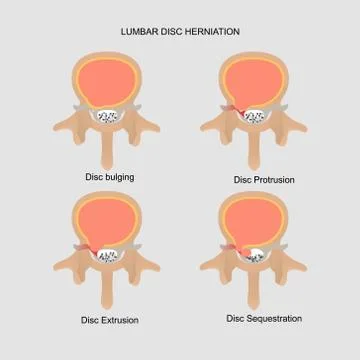 Vector ilustration of lumbar disc herniation Stock Illustration