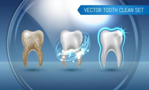 Vector set of 3d realistic clean and dirty tooth on blue background, clearing Stock Illustration