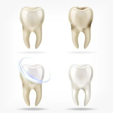 Vector set of 3d realistic clean and dirty tooth , clearing tooth process. Or Stock Illustration
