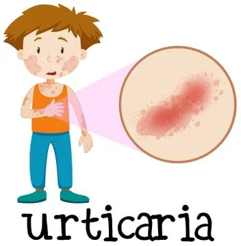 A Vector of Skin Urticaria 스톡 일러스트