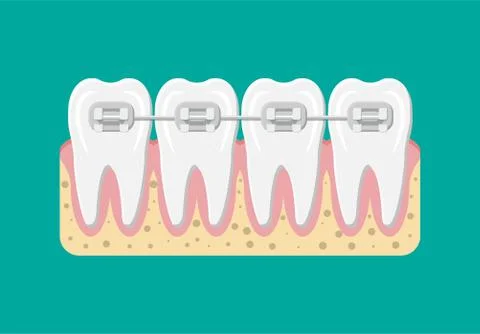 Vector teeth braces flat illustration Stock Illustration