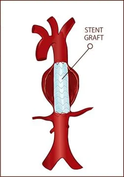 Vector - Thoracic (descending) aortic aneurysm and endovascular surgery Illustrazione stock