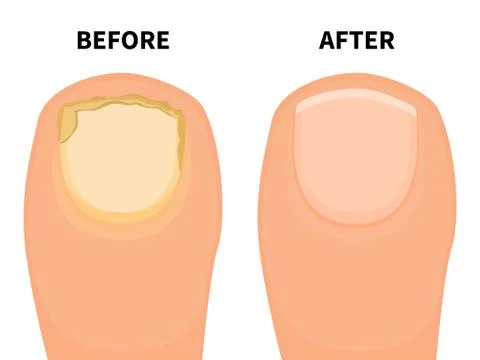 Vector toe nail before and after fungal disease Stock Illustration