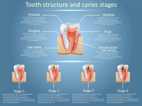 Vector tooth structure diagram and dental caries stages Stock Illustration