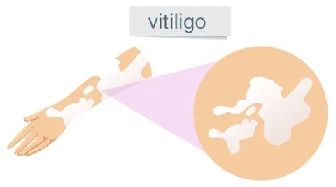A Vector of Vitiligo on Skin Stock-Illustration