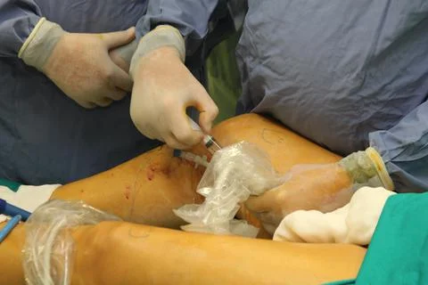 Vein injection Photos