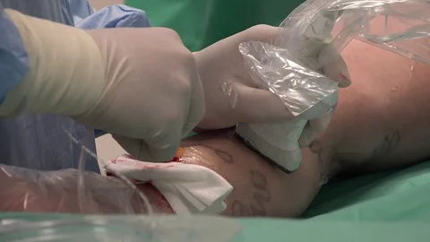 Vein Laser Surgery 2 Stock Footage 108048677