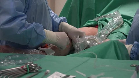 Vein Laser Surgery 3 Stock Footage 108048673