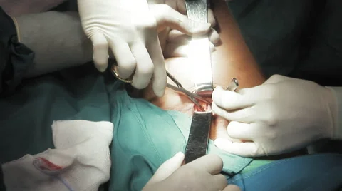 Vein stripping surgery close up Stock-Footage 67282678