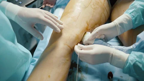 Vein surgery procedure on leg Video stock 270539736
