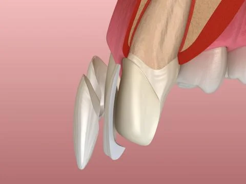 Veneer installation procedure over central incisor and lateral incisor. Slice Stock Illustration