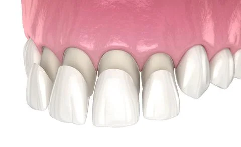 Veneer installation procedure over central incisor and lateral incisor. Stock Illustration