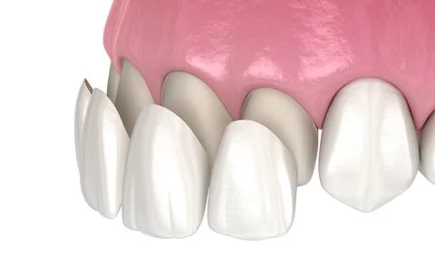 Veneer installation procedure over central incisor and lateral incisor. Stock-Illustration