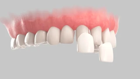 Veneers installation 動画素材 196386881