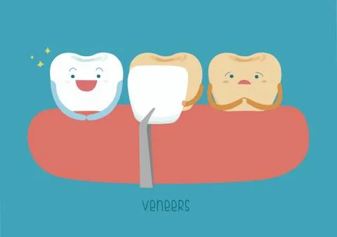 Veneers teeth of dental Stock Illustration