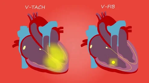 Ventricular Arrhythmia 3D Heart Model Tachycardia Fibrillation Lower Chamber Video stock 337514212