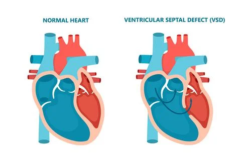 Ventricular septal defect VSD. Human heart muscle diseases cross-section Stock Illustration