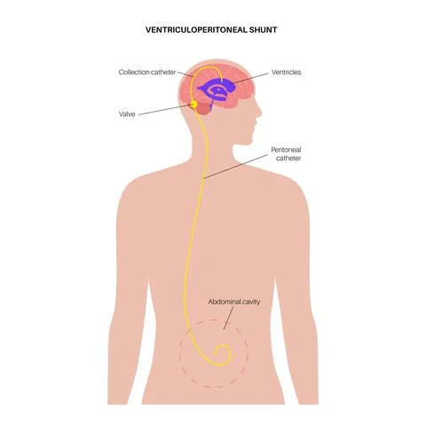 Ventriculoperitoneal shunt concept Stock Illustration