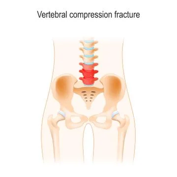 Vertebral compression fracture 스톡 일러스트