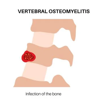 Vertebral osteomyelitis poster Stock Illustration