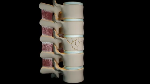 Vertebroplasty Procedure Stock Footage 122639281