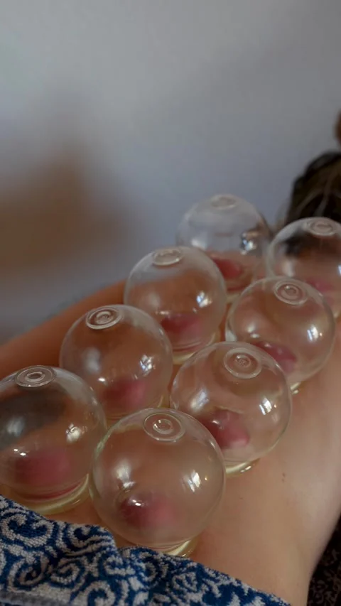 Vertical close-up of glass vacuum cupping therapy on a client’s back, showing Vidéo 336744284