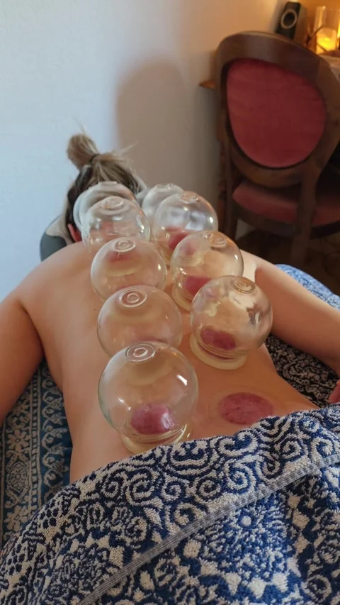Vertical close up of glass vacuum cups placed on a woman's back Vidéo 336307571