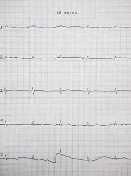 Vertical closeup of an ECG graph on a paper, electrocardiograph Fotos de archivo