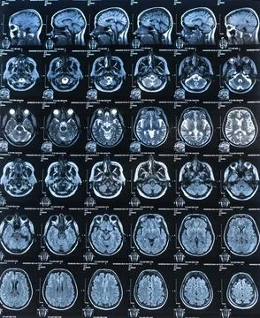 Vertical CT scan image of human brain. Mri or x-ray scan for diagnostic hum.. Stock Photos