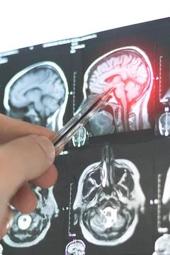 Vertical CT scan image of human brain. Mri or x-ray scan for diagnostic hum.. Stock Photos