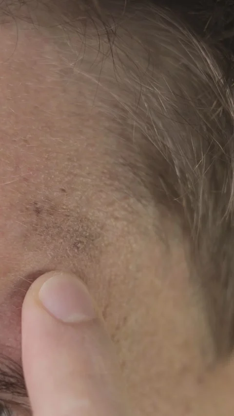 Vertical footage of a pigmented spots Stock Footage 288115072