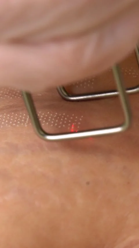 Vertical frame macro shot of fractional CO2 laser stretch marks removal Stock Footage 334732727